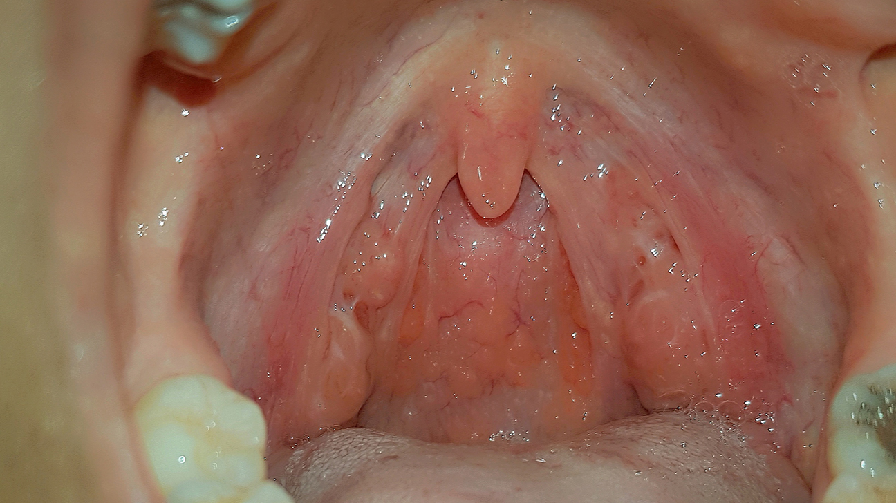 Tonsil Cancers